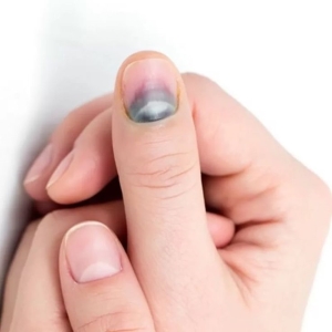 Daumen mit Nagelhämatom